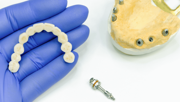 Dental Implant Removal
