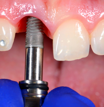 Classification of periodontal health and conditions